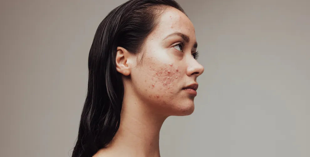 Acne Hacks and Long-Term Solutions