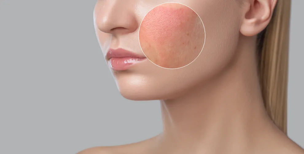 Skin Inflammation: Five Causes and Treatment