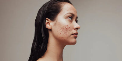 Acne Hacks and Long-Term Solutions