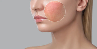 Skin Inflammation: Five Causes and Treatment